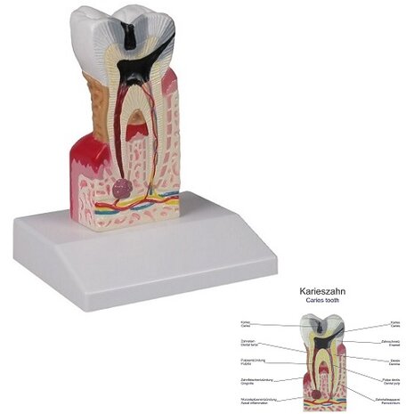 Anatomie model tand cari&euml;s, 10x ware grootte