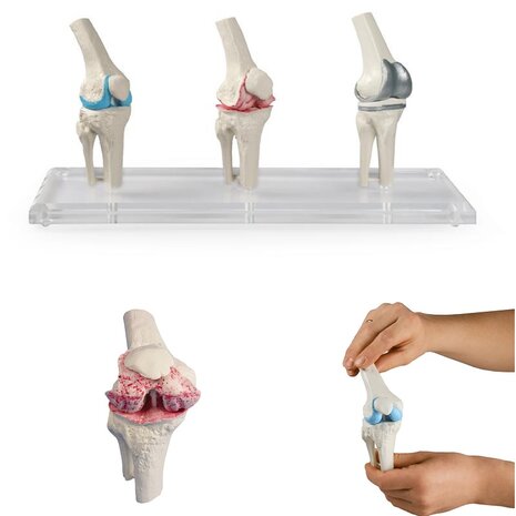 Anatomie model knie-implantaat