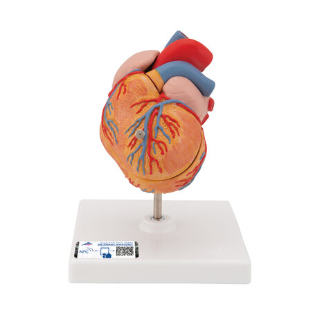 Anatomie model hart met linkerventrikel hypertrofie (LVH), 2-delig