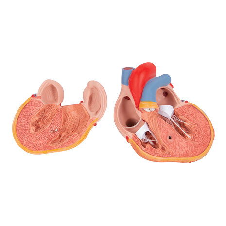 Anatomie model hart met linkerventrikel hypertrofie (LVH), 2-delig