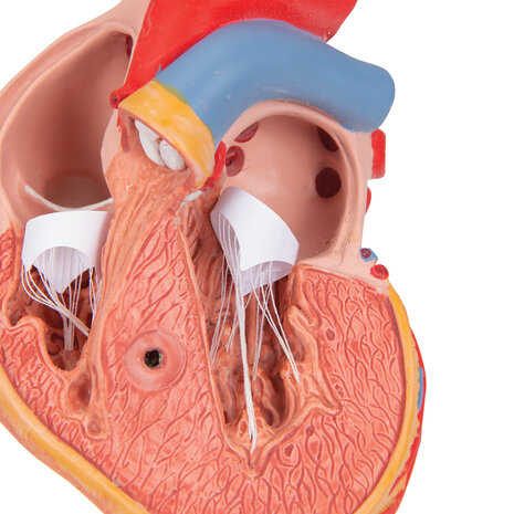 Anatomie model hart met linkerventrikel hypertrofie (LVH), 2-delig