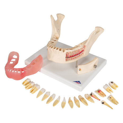 Anatomie model tandziekten, 21-delig, 18x26x19 cm