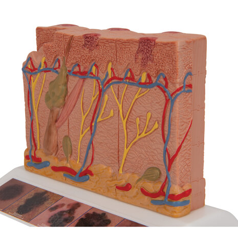 Anatomie model huidkanker, 6 stadia, 14x10x12 cm