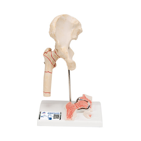 Anatomie model heupfractuur en artrose