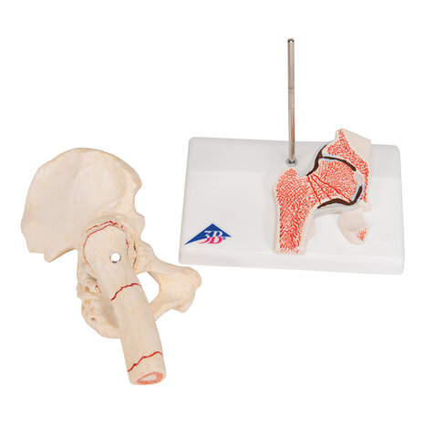 Anatomie model heupfractuur en artrose