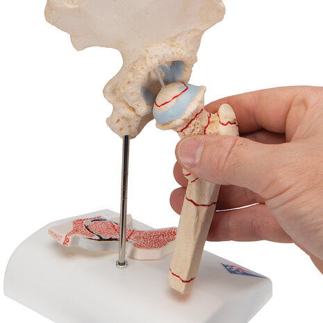 Anatomie model heupfractuur en artrose