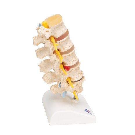 Anatomie model degeneratie wervelkolom