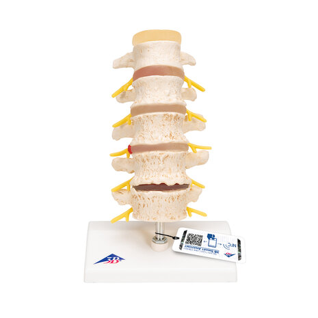 Anatomie model degeneratie wervelkolom