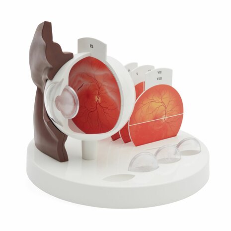 Anatomie model oog, pathologie, 5x ware grootte, 26x26x21 cm